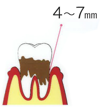 歯周炎（中度）　４〜７mm